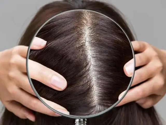 Rụng Tóc Hói Đầu Ở Nữ: Nguyên Nhân, Dấu Hiệu & Cách Cải Thiện Hiệu Quả