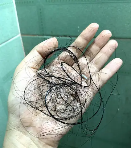 Rụng Tóc Nhiều Có Sao Không? Nguyên Nhân, Dấu Hiệu Nguy Hiểm & Cách Xử Lý Hiệu Quả Rụng Tóc Nhiều Có Sao Không? Nguyên Nhân, Dấu Hiệu Nguy Hiểm & Cách Xử Lý Hiệu Quả