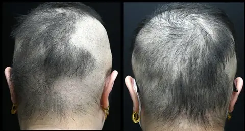 Rụng Tóc Nhiều Là Bị Làm Sao? Nguyên Nhân, Dấu Hiệu Và Cách Khắc Phục Hiệu Quả