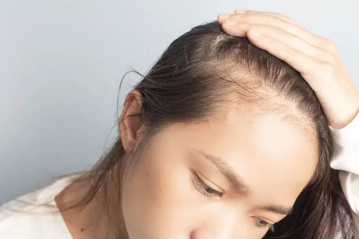 Rụng Tóc Nhiều Ở Nữ: Nguyên Nhân, Dấu Hiệu Và Biện Pháp Khắc Phục Hiệu Quả