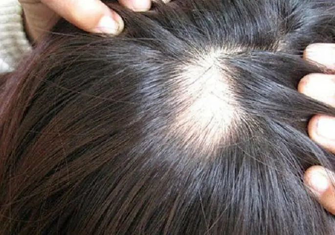 Rụng Tóc Nhiều Ở Nữ Có Sao Không? Nguyên Nhân & Cách Khắc Phục Toàn Diện
