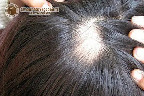 Rụng Tóc Nhiều Ở Nữ: Hiểu Rõ Nguyên Nhân & Bệnh Lý Tiềm Ẩn