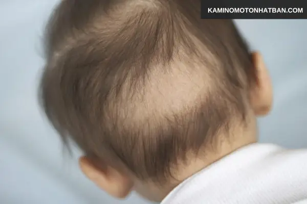 Trẻ 1 Tháng Tuổi Bị Rụng Tóc Vành Khăn: Nguyên Nhân, Cách Xử Lý Và Khi Nào Cần Đi Khám? Trẻ 1 Tháng Tuổi Bị Rụng Tóc Vành Khăn: Nguyên Nhân, Cách Xử Lý Và Khi Nào Cần Đi Khám?