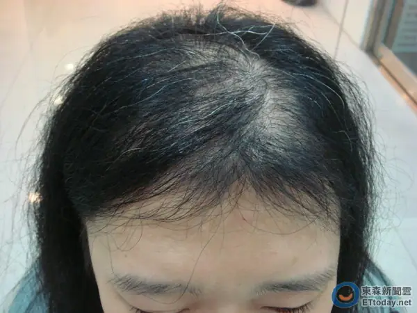 Rụng Lông Mi & Rụng Tóc: Nguyên Nhân Sâu Xa, Cách Nhận Biết Và Giải Pháp Toàn Diện Rụng Lông Mi & Rụng Tóc: Nguyên Nhân Sâu Xa, Cách Nhận Biết Và Giải Pháp Toàn Diện