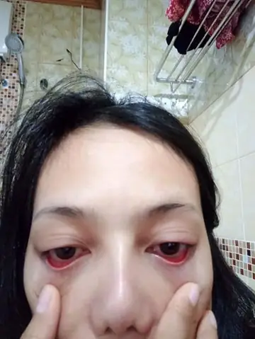 Rụng Lông Mi & Rụng Tóc: Nguyên Nhân Sâu Xa, Cách Nhận Biết Và Giải Pháp Toàn Diện Rụng Lông Mi & Rụng Tóc: Nguyên Nhân Sâu Xa, Cách Nhận Biết Và Giải Pháp Toàn Diện