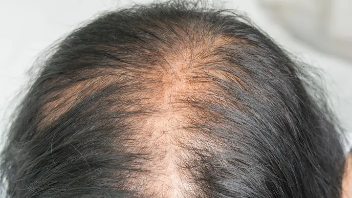Rụng Tóc Sau Sinh Kéo Dài Bao Lâu? Nguyên Nhân & Cách Phục Hồi Tóc Toàn Diện