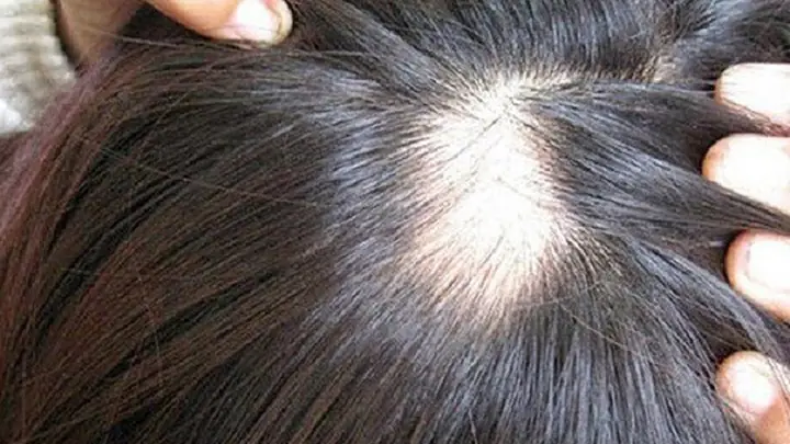 Rụng Tóc Từng Mảng Có Mọc Lại Không? Nguyên Nhân, Dấu Hiệu Và Cách Điều Trị Hiệu Quả Rụng Tóc Từng Mảng Có Mọc Lại Không? Nguyên Nhân, Dấu Hiệu Và Cách Điều Trị Hiệu Quả