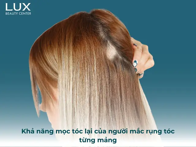 Rụng Tóc Từng Mảng Có Mọc Lại Không? Nguyên Nhân, Dấu Hiệu Và Cách Điều Trị Hiệu Quả Rụng Tóc Từng Mảng Có Mọc Lại Không? Nguyên Nhân, Dấu Hiệu Và Cách Điều Trị Hiệu Quả