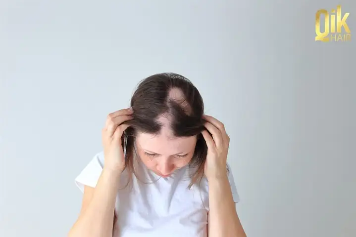 Rụng Tóc Từng Mảng Ở Phụ Nữ: Nguyên Nhân, Dấu Hiệu, Cách Điều Trị Hiệu Quả
