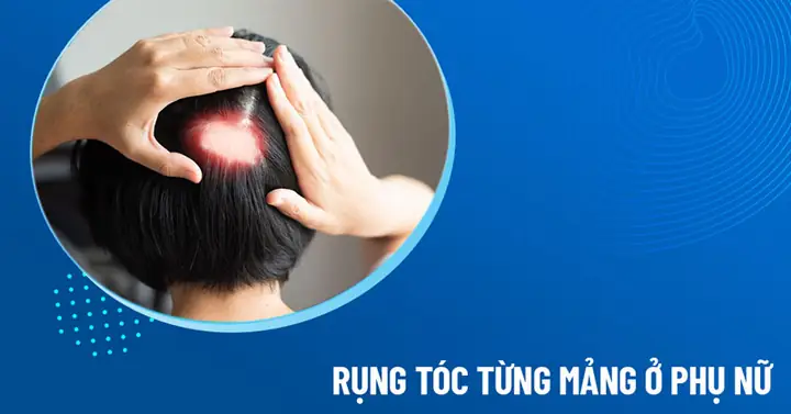 Rụng Tóc Từng Mảng Ở Phụ Nữ: Nguyên Nhân, Dấu Hiệu, Cách Điều Trị Hiệu Quả