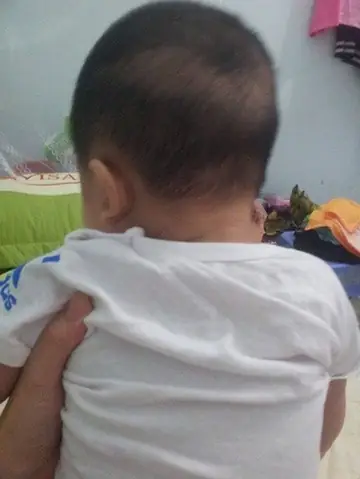 Rụng Tóc Vành Khăn Ở Trẻ 1 Tuổi: Nguyên Nhân, Dấu Hiệu & Cách Khắc Phục Cho Bé Rụng Tóc Vành Khăn Ở Trẻ 1 Tuổi: Nguyên Nhân, Dấu Hiệu & Cách Khắc Phục Cho Bé