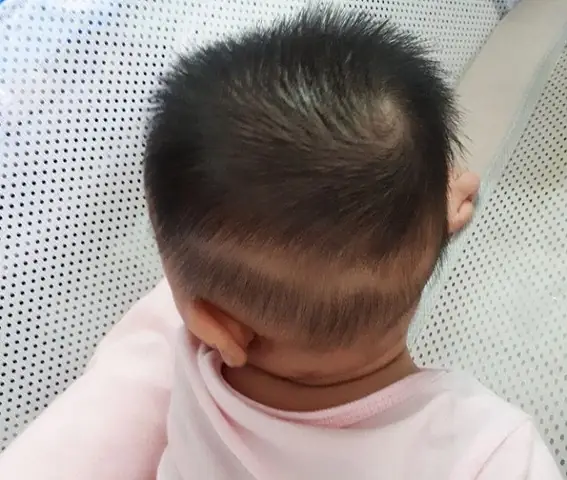 Rụng Tóc Vành Khăn Ở Trẻ 1 Tuổi: Nguyên Nhân, Dấu Hiệu & Cách Khắc Phục Cho Bé Rụng Tóc Vành Khăn Ở Trẻ 1 Tuổi: Nguyên Nhân, Dấu Hiệu & Cách Khắc Phục Cho Bé