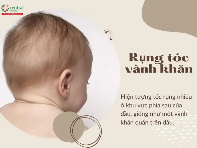 Rụng Tóc Vành Khăn Ở Trẻ 1 Tuổi: Nguyên Nhân, Dấu Hiệu & Cách Khắc Phục Cho Bé Rụng Tóc Vành Khăn Ở Trẻ 1 Tuổi: Nguyên Nhân, Dấu Hiệu & Cách Khắc Phục Cho Bé