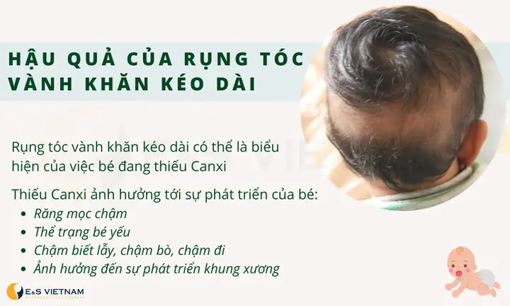 Trẻ Rụng Tóc Vành Khăn Thiếu Canxi: Nguyên Nhân, Dấu Hiệu Và Cách Xử Lý
