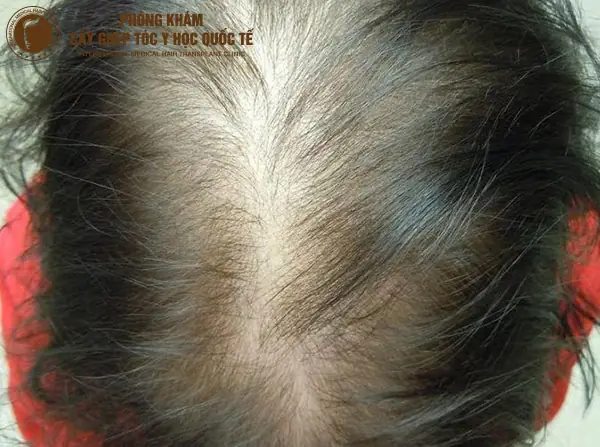Sợi Tóc Dày Và Cứng: Nguyên Nhân, Đặc Điểm Và Cách Chăm Sóc Hiệu Quả