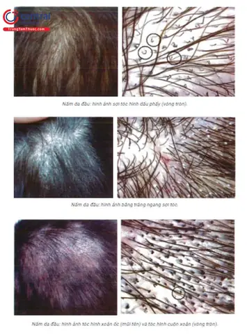 Sợi Tóc Có Đoạn Dày Đoạn Mỏng: Nguyên Nhân, Dấu Hiệu & Cách Xử Lý Hiệu Quả Sợi Tóc Có Đoạn Dày Đoạn Mỏng: Nguyên Nhân, Dấu Hiệu & Cách Xử Lý Hiệu Quả