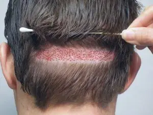 Tác Hại Tiềm Ẩn Của Cấy Tóc: Nguy Cơ Và Cách Phòng Tránh Toàn Diện