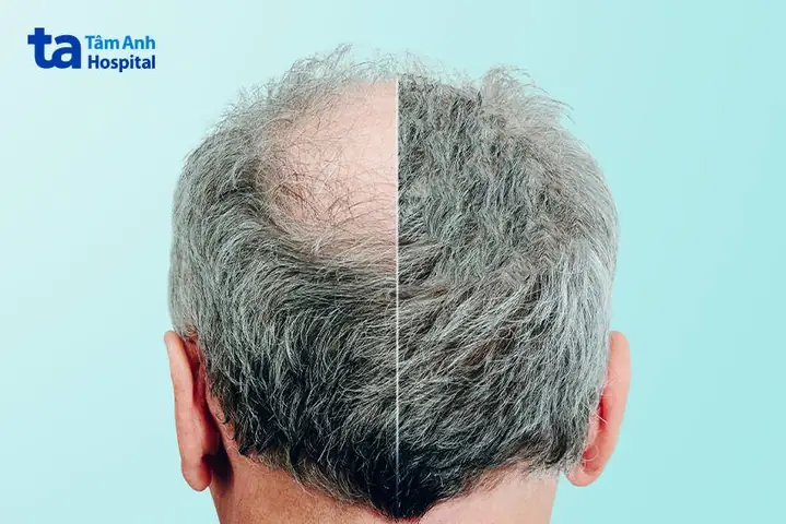 Thiếu Tinh Bột Gây Rụng Tóc: Hiểu Rõ Nguyên Nhân & Cách Khắc Phục Hiệu Quả Thiếu Tinh Bột Gây Rụng Tóc: Hiểu Rõ Nguyên Nhân & Cách Khắc Phục Hiệu Quả
