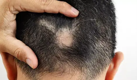 Top 10 Thuốc Trị Rụng Tóc Từng Mảng Hiệu Quả & Cách Điều Trị
