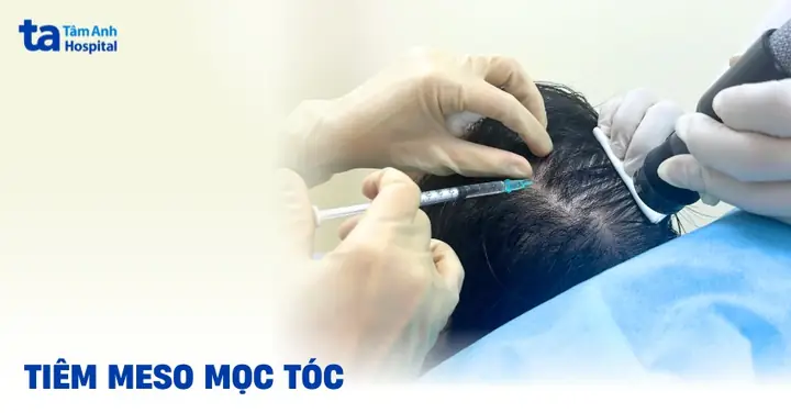 Tiêm Meso Mọc Tóc Có Hiệu Quả Không? Sự Thật Về Phương Pháp Kích Thích Mọc Tóc Tiêm Meso Mọc Tóc Có Hiệu Quả Không? Sự Thật Về Phương Pháp Kích Thích Mọc Tóc