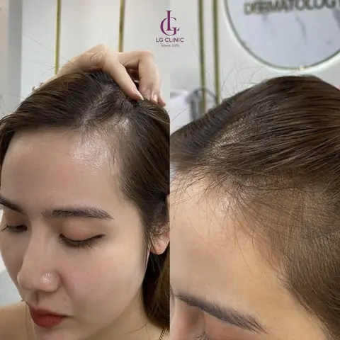 Tiêm Meso Mọc Tóc Có Hiệu Quả Không? Sự Thật Về Phương Pháp Kích Thích Mọc Tóc Tiêm Meso Mọc Tóc Có Hiệu Quả Không? Sự Thật Về Phương Pháp Kích Thích Mọc Tóc