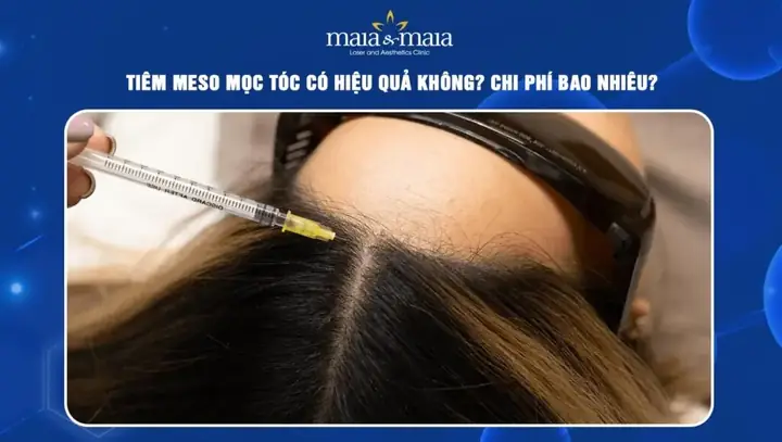 Tiêm Meso Mọc Tóc Có Hiệu Quả Không? Sự Thật Về Phương Pháp Kích Thích Mọc Tóc Tiêm Meso Mọc Tóc Có Hiệu Quả Không? Sự Thật Về Phương Pháp Kích Thích Mọc Tóc