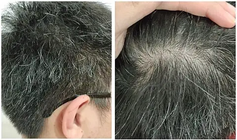Tóc Bạc Mọc Ở Đỉnh Đầu: Cảnh Báo Sức Khỏe, Nguyên Nhân & Cách Xử Lý Hiệu Quả
