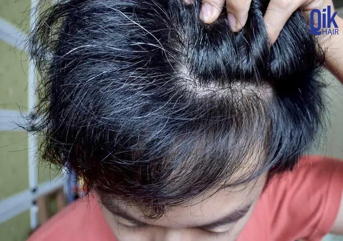 Tóc Bạc Nhổ Đi Có Mọc Lại Không? Giải Đáp Chi Tiết Từ Chuyên Gia