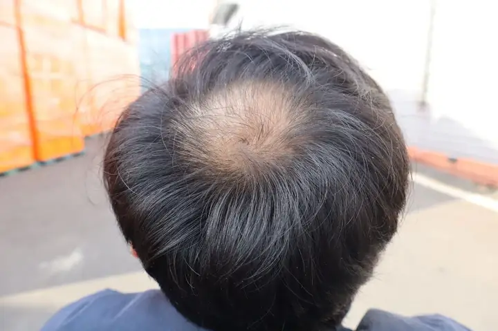 Rụng Tóc Nhiều Ở Nam Giới: Nguyên Nhân, Dấu Hiệu & Cách Khắc Phục Toàn Diện