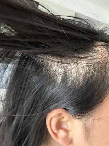 Tóc Mỏng Dần: Nguyên Nhân Sâu Xa, Giải Pháp Toàn Diện Và Cách Phục Hồi Hiệu Quả Tóc Mỏng Dần: Nguyên Nhân Sâu Xa, Giải Pháp Toàn Diện Và Cách Phục Hồi Hiệu Quả