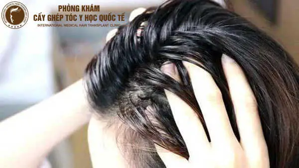 Tóc Da Dầu Phải Làm Sao: Bí Quyết Giảm Nhờn, Tóc Bồng Bềnh Tự Nhiên Tóc Da Dầu Phải Làm Sao: Bí Quyết Giảm Nhờn, Tóc Bồng Bềnh Tự Nhiên