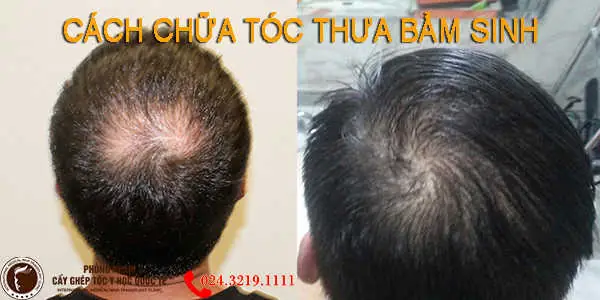 Tóc Ít Bẩm Sinh Thì Phải Làm Sao? Cách Cải Thiện Hiệu Quả Nhất