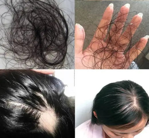 Rụng Tóc Bao Nhiêu Sợi Mỗi Ngày Là Bình Thường? Phân Biệt Rụng Tóc Sinh Lý Và Bệnh Lý