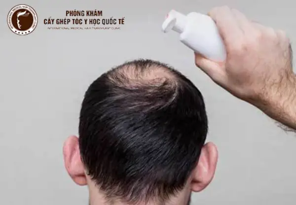 Tóc Thưa Ở Xoáy Nam: Nguyên Nhân, Dấu Hiệu & Giải Pháp Tối Ưu Hóa Tóc Dày Mượt