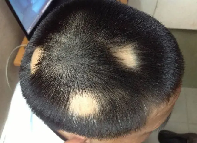 Rụng Tóc Từng Mảng: Nguyên Nhân, Cách Nhận Biết Và Giải Pháp Toàn Diện Rụng Tóc Từng Mảng: Nguyên Nhân, Cách Nhận Biết Và Giải Pháp Toàn Diện