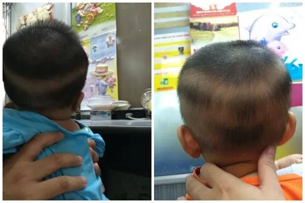 Tóc Vành Khăn Ở Trẻ Là Gì? Nguyên Nhân, Dấu Hiệu & Cách Xử Lý An Toàn Tóc Vành Khăn Ở Trẻ Là Gì? Nguyên Nhân, Dấu Hiệu & Cách Xử Lý An Toàn
