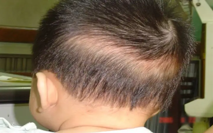 Trẻ 11 Tuổi Bị Rụng Tóc: Nguyên Nhân, Dấu Hiệu & Cách Xử Lý Hiệu Quả Trẻ 11 Tuổi Bị Rụng Tóc: Nguyên Nhân, Dấu Hiệu & Cách Xử Lý Hiệu Quả