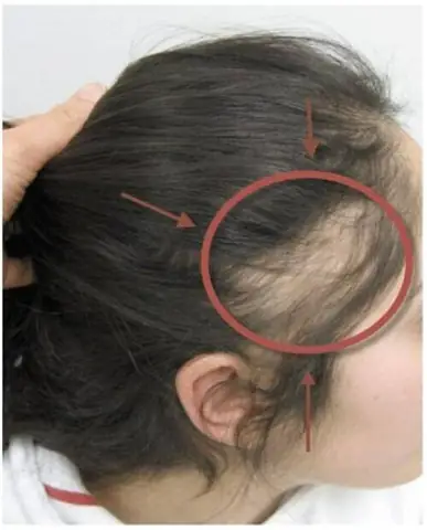 Trẻ 14 Tuổi Bị Rụng Tóc Nhiều: Nguyên Nhân Sâu Xa Và Giải Pháp Toàn Diện Trẻ 14 Tuổi Bị Rụng Tóc Nhiều: Nguyên Nhân Sâu Xa Và Giải Pháp Toàn Diện