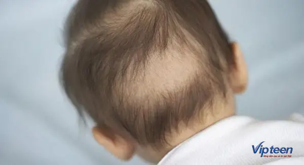 Trẻ Bị Rụng Tóc Từng Mảng: Nguyên Nhân, Dấu Hiệu Và Cách Xử Lý Hiệu Quả Cho Cha Mẹ Trẻ Bị Rụng Tóc Từng Mảng: Nguyên Nhân, Dấu Hiệu Và Cách Xử Lý Hiệu Quả Cho Cha Mẹ