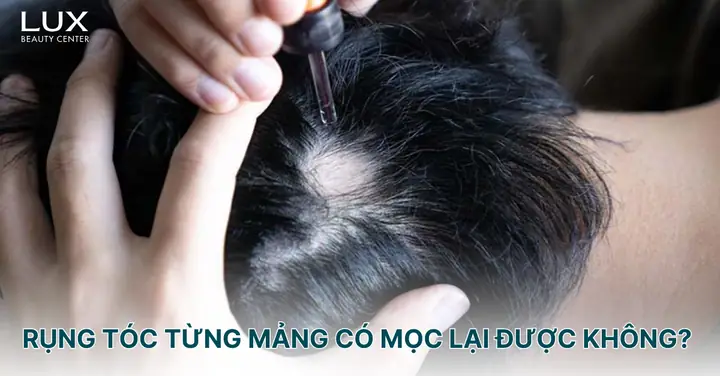 Trẻ Bị Rụng Tóc Từng Mảng: Nguyên Nhân, Dấu Hiệu Và Cách Xử Lý Hiệu Quả Cho Cha Mẹ Trẻ Bị Rụng Tóc Từng Mảng: Nguyên Nhân, Dấu Hiệu Và Cách Xử Lý Hiệu Quả Cho Cha Mẹ