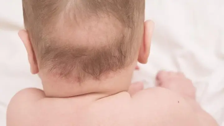 Trẻ Rụng Tóc Vành Khăn Kèm Ra Mồ Hôi Trộm: Dấu Hiệu Còi Xương Hay Thiếu Chất? Trẻ Rụng Tóc Vành Khăn Kèm Ra Mồ Hôi Trộm: Dấu Hiệu Còi Xương Hay Thiếu Chất?