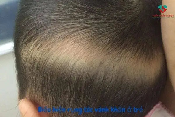 Trẻ Bị Rụng Tóc Vành Khăn Nên Uống Gì Để Bổ Sung Dưỡng Chất?