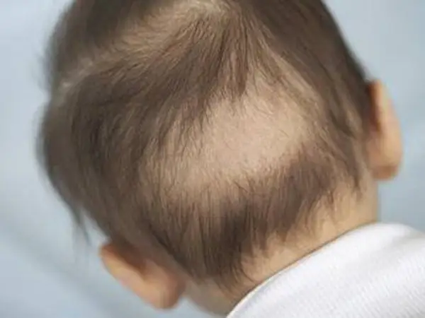 Trẻ Rụng Tóc Vành Khăn: Liệu Có Phải Dấu Hiệu Thiếu Canxi? Hướng Dẫn Chăm Sóc Toàn Diện