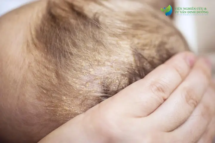 Trẻ Sơ Sinh Bị Rụng Tóc: Bệnh Gì Hay Là Hiện Tượng Sinh Lý Bình Thường? Trẻ Sơ Sinh Bị Rụng Tóc: Bệnh Gì Hay Là Hiện Tượng Sinh Lý Bình Thường?