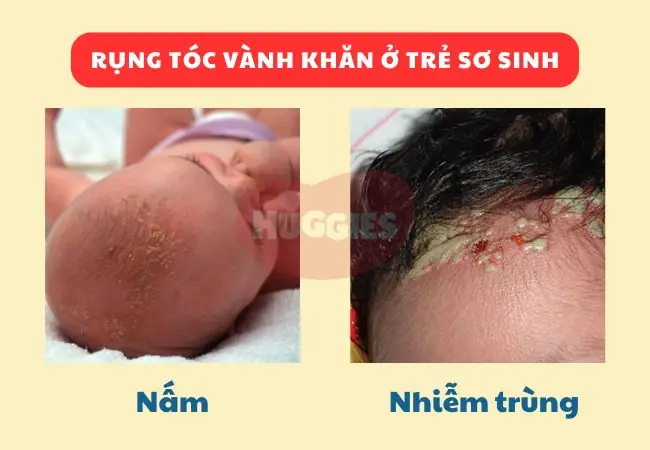 Trẻ Sơ Sinh Bị Rụng Tóc: Bệnh Gì Hay Là Hiện Tượng Sinh Lý Bình Thường? Trẻ Sơ Sinh Bị Rụng Tóc: Bệnh Gì Hay Là Hiện Tượng Sinh Lý Bình Thường?