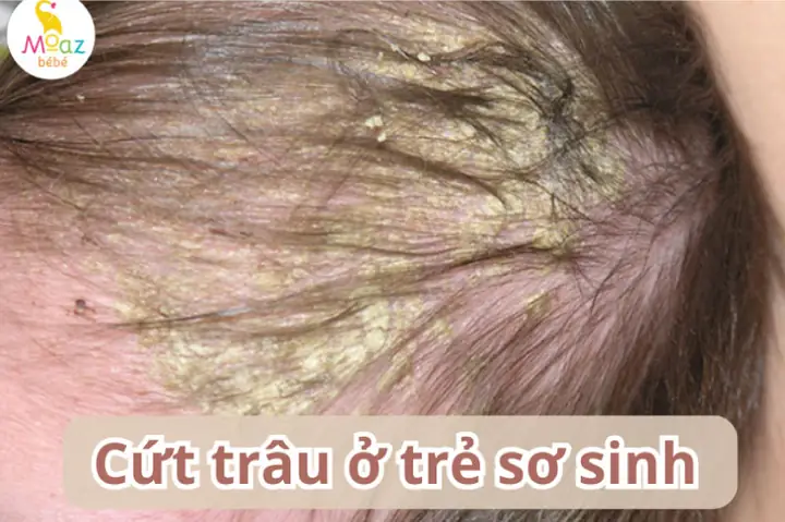 Trẻ Sơ Sinh Đi Ngoài Ra Tóc: Nguyên Nhân, Dấu Hiệu Bất Thường & Cách Xử Lý An Toàn