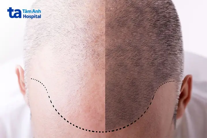 Rụng Tóc Ở Nam Giới: Nguyên Nhân, Triệu Chứng & Cách Khắc Phục Hiệu Quả