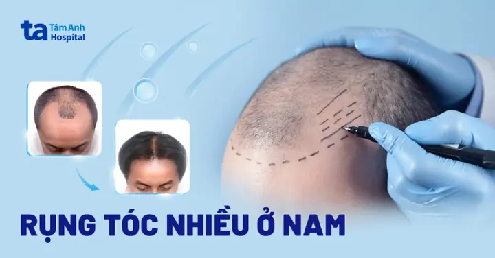 Rụng Tóc Ở Nam Giới: Nguyên Nhân, Triệu Chứng & Cách Khắc Phục Hiệu Quả