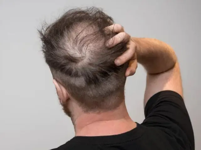 Tự Dưng Rụng Tóc Nhiều: Nguyên Nhân, Dấu Hiệu & Cách Khắc Phục Hiệu Quả Tự Dưng Rụng Tóc Nhiều: Nguyên Nhân, Dấu Hiệu & Cách Khắc Phục Hiệu Quả