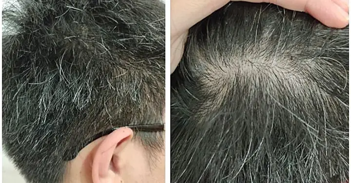 Vì Sao Tóc Bạc Sớm? Nguyên Nhân, Dấu Hiệu Và Cách Ngăn Ngừa Hiệu Quả